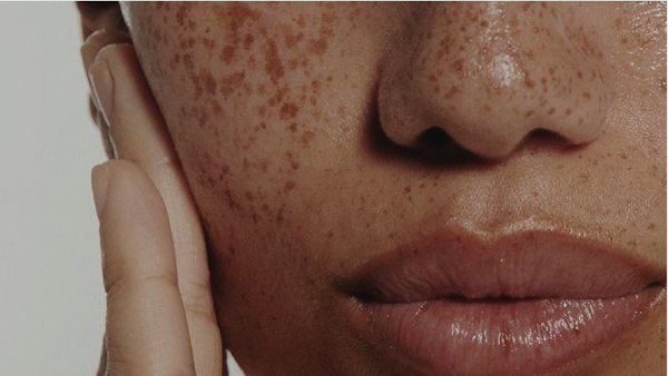 Beauty Marks