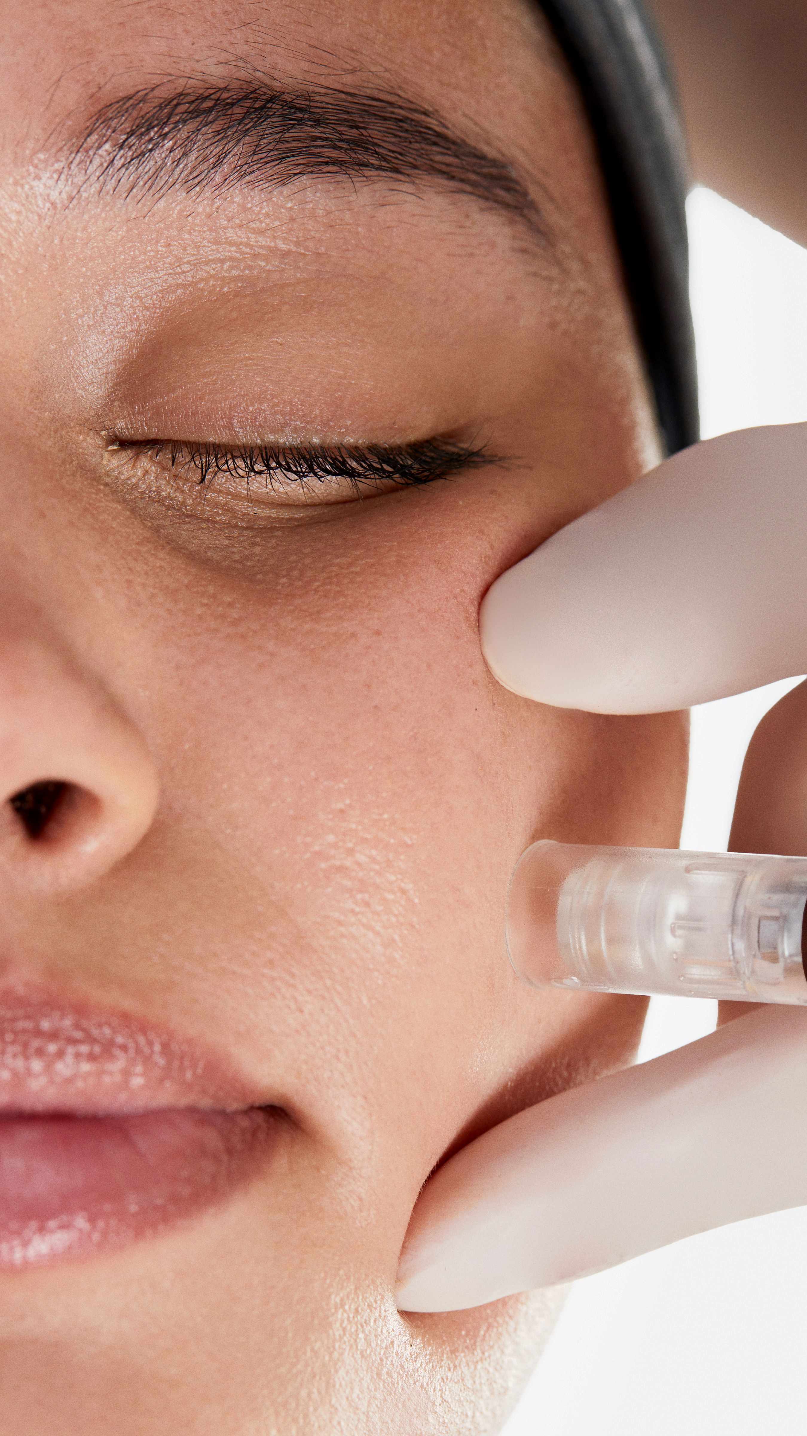 pro skin needling with skin peel